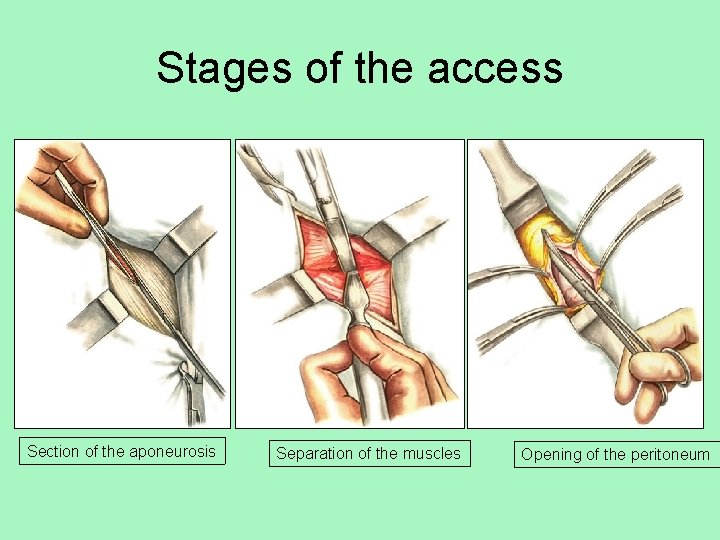 Stages of the access Section of the aponeurosis Separation of the muscles Opening of