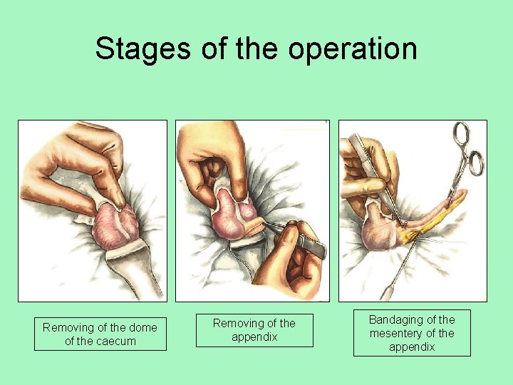 Stages of the operation Removing of the dome of the caecum Removing of the