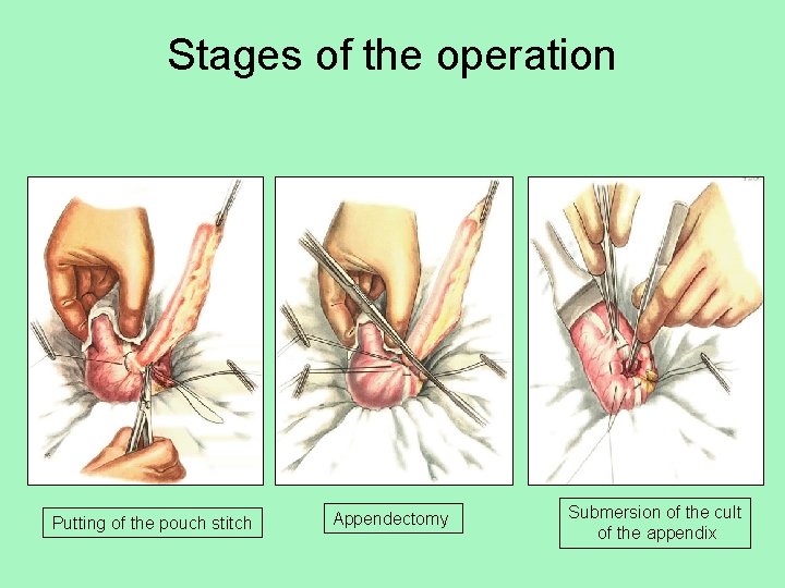 Stages of the operation Putting of the pouch stitch Appendectomy Submersion of the cult