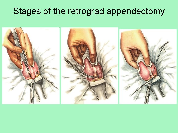 Stages of the retrograd appendectomy 