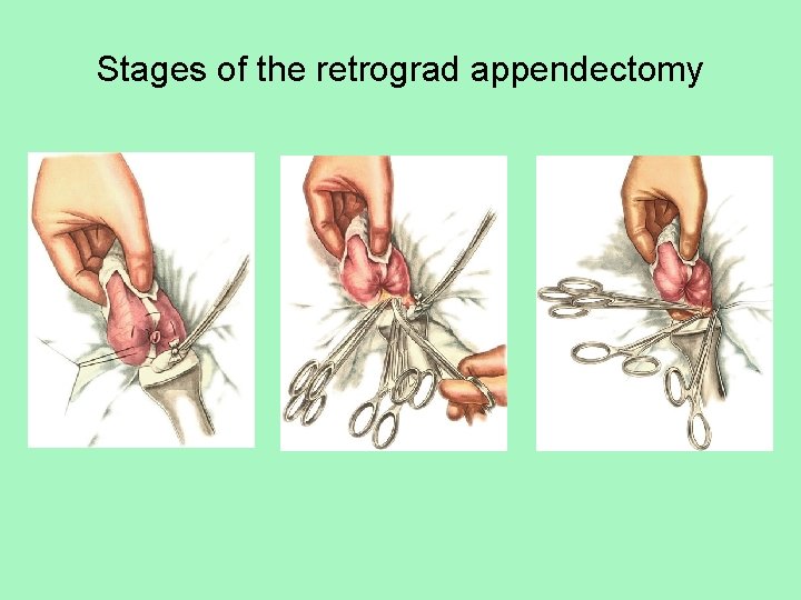 Stages of the retrograd appendectomy 