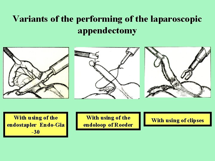 Variants of the performing of the laparoscopic appendectomy With using of the endostapler Endo-Gia