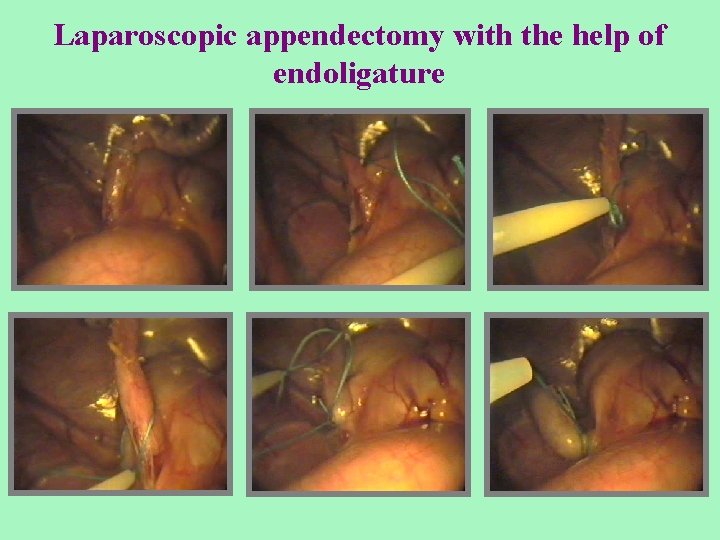 Laparoscopic appendectomy with the help of endoligature 