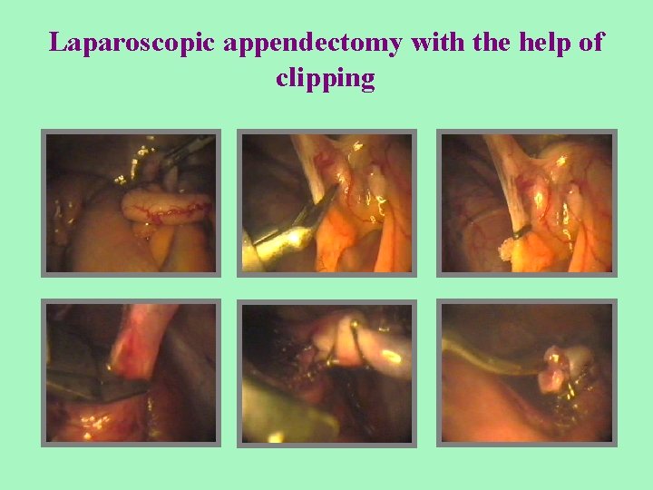 Laparoscopic appendectomy with the help of clipping 