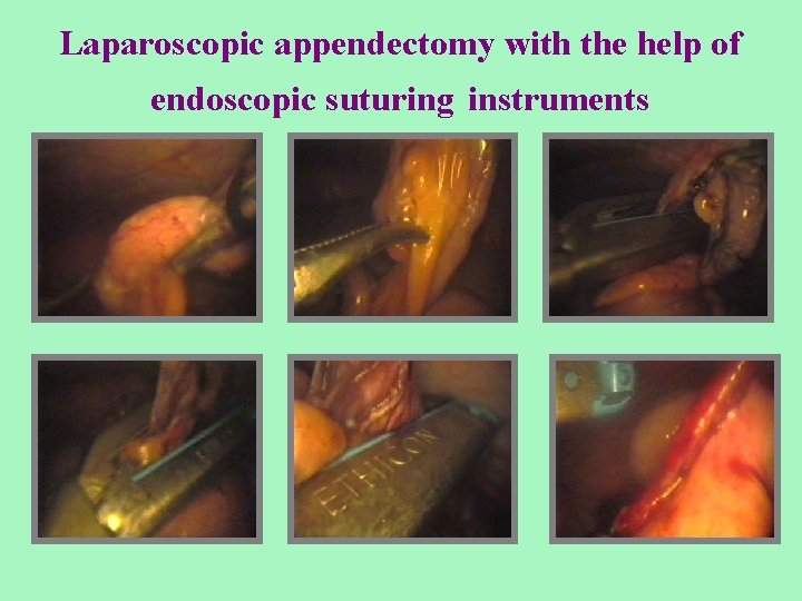 Laparoscopic appendectomy with the help of endoscopic suturing instruments 