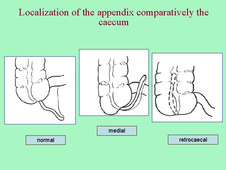 Localization of the appendix comparatively the caecum medial normal retrocaecal 