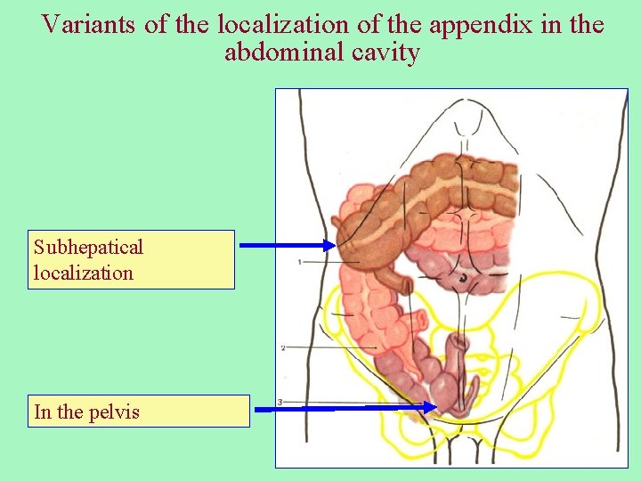 Variants of the localization of the appendix in the abdominal cavity Subhepatical localization In