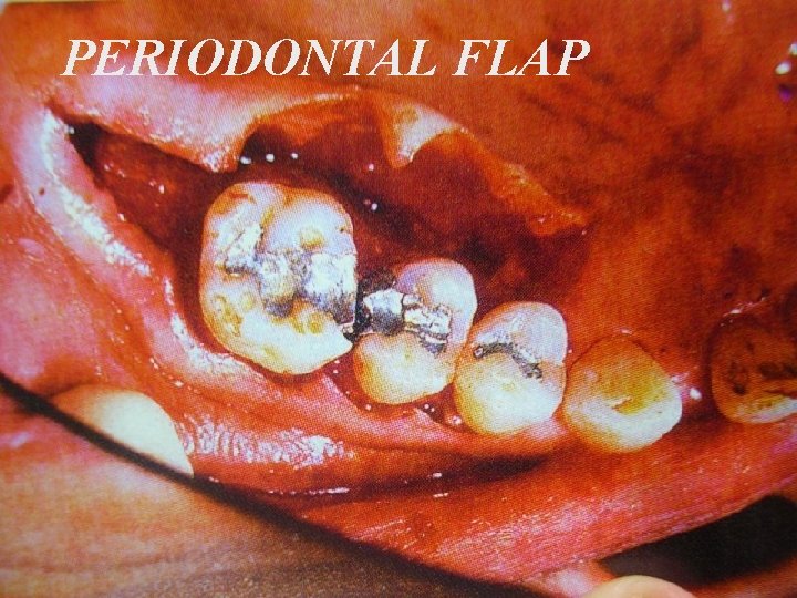PERIODONTAL FLAP 