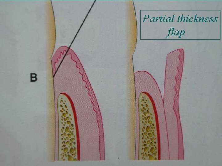 Partial thickness flap 