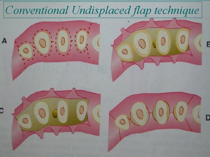 Conventional Undisplaced flap technique 