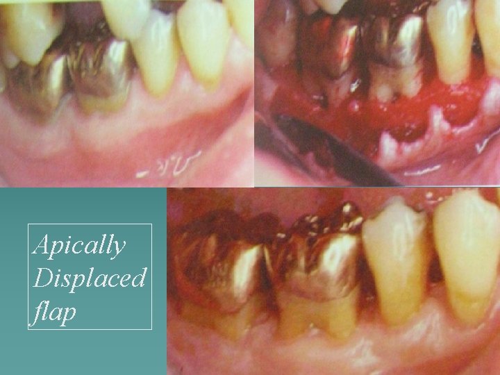 Apically Displaced flap 