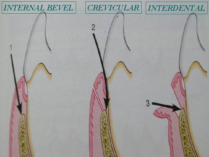 INTERNAL BEVEL CREVICULAR INTERDENTAL 