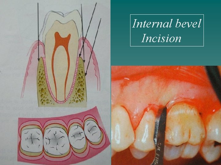 Internal bevel Incision 