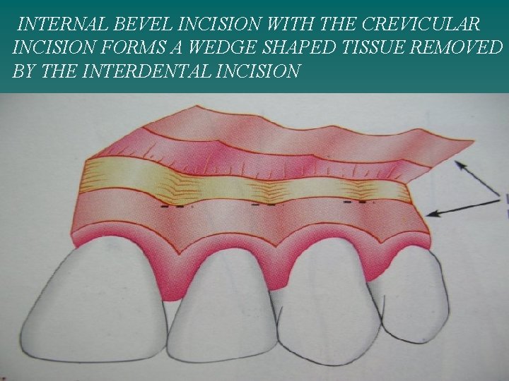 INTERNAL BEVEL INCISION WITH THE CREVICULAR INCISION FORMS A WEDGE SHAPED TISSUE REMOVED BY