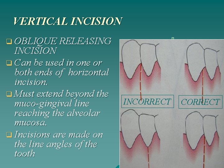 VERTICAL INCISION q OBLIQUE RELEASING INCISION q Can be used in one or both