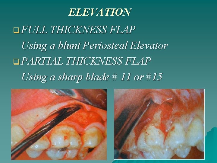 ELEVATION q FULL THICKNESS FLAP Using a blunt Periosteal Elevator q PARTIAL THICKNESS FLAP