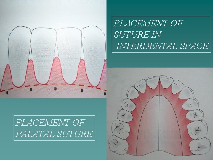 PLACEMENT OF SUTURE IN INTERDENTAL SPACE PLACEMENT OF PALATAL SUTURE 