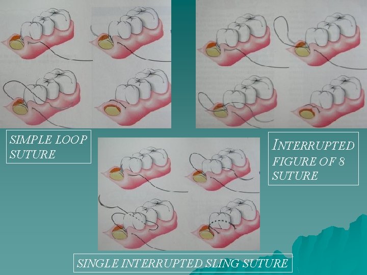 SIMPLE LOOP SUTURE INTERRUPTED FIGURE OF 8 SUTURE SINGLE INTERRUPTED SLING SUTURE 