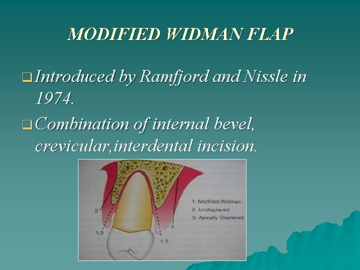 MODIFIED WIDMAN FLAP q Introduced by Ramfjord and Nissle in 1974. q Combination of