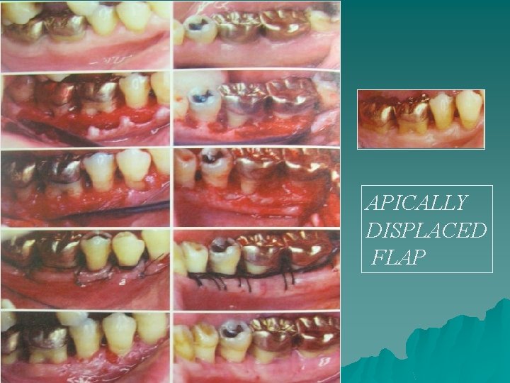 APICALLY DISPLACED FLAP 