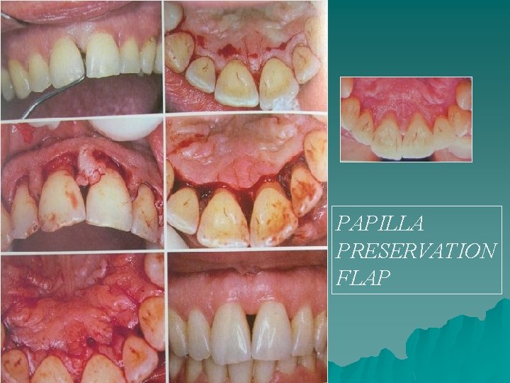 PAPILLA PRESERVATION FLAP 