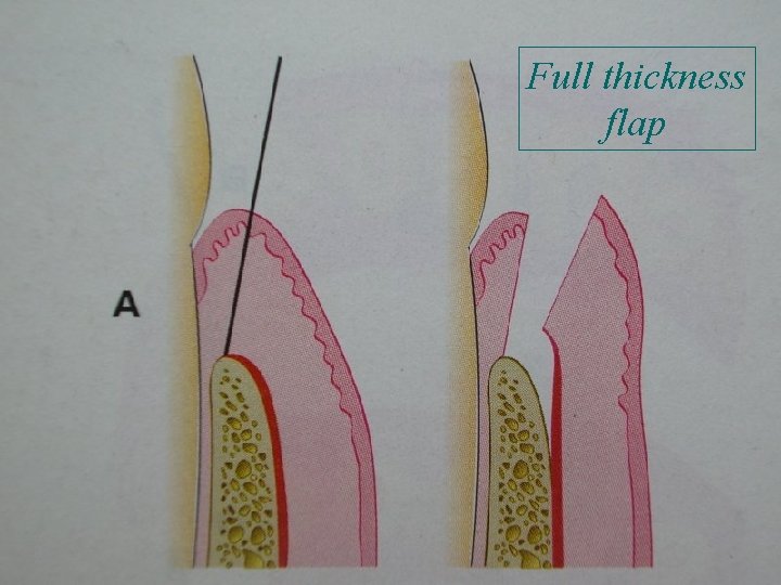 Full thickness flap 