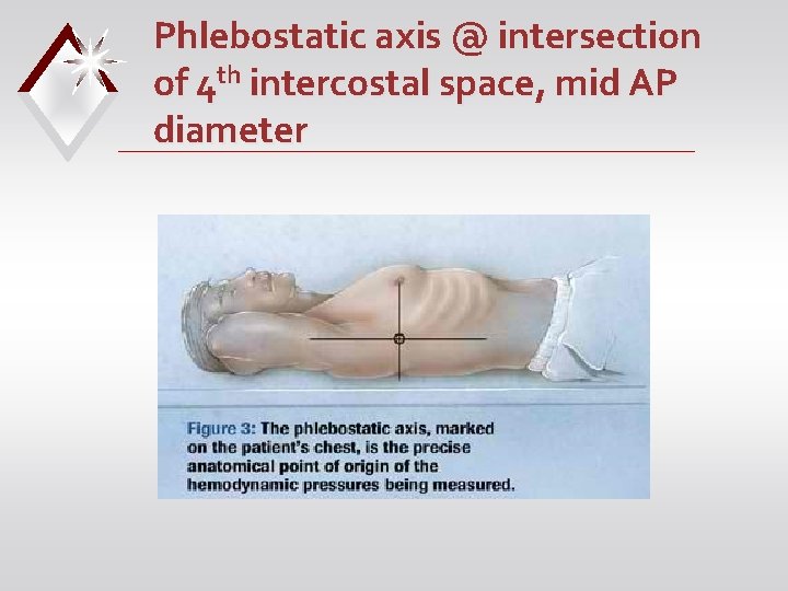 Phlebostatic axis @ intersection of 4 th intercostal space, mid AP diameter 