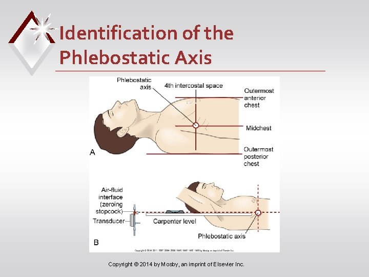 Identification of the Phlebostatic Axis Copyright © 2014 by Mosby, an imprint of Elsevier