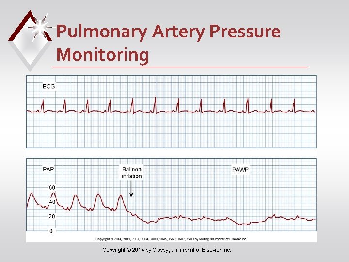 Pulmonary Artery Pressure Monitoring Copyright © 2014 by Mosby, an imprint of Elsevier Inc.