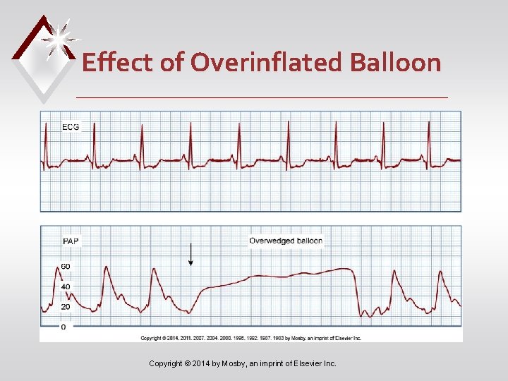 Effect of Overinflated Balloon Copyright © 2014 by Mosby, an imprint of Elsevier Inc.