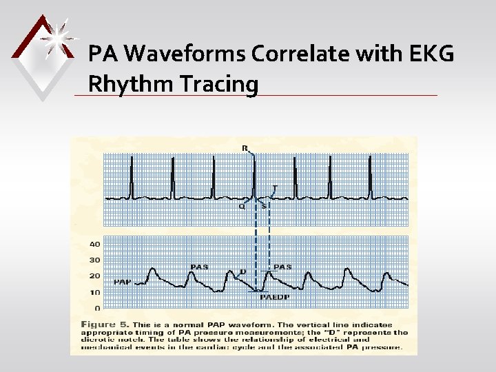 PA Waveforms Correlate with EKG Rhythm Tracing 