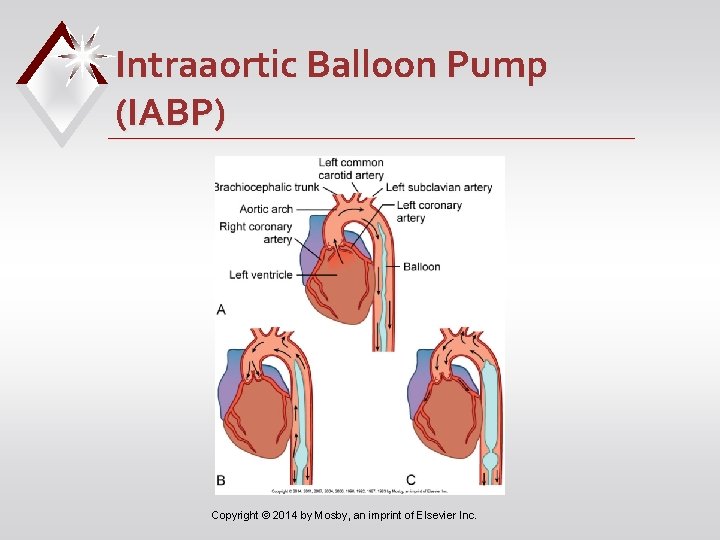 Intraaortic Balloon Pump (IABP) Copyright © 2014 by Mosby, an imprint of Elsevier Inc.