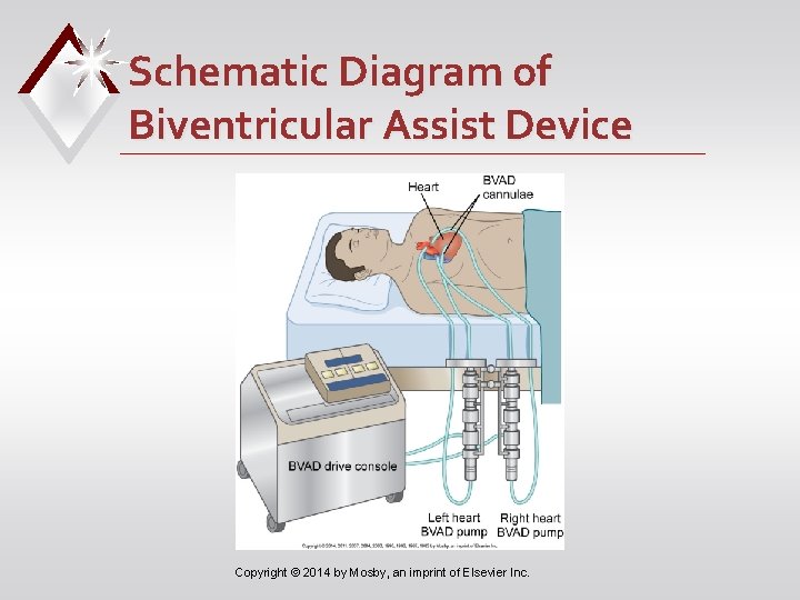 Schematic Diagram of Biventricular Assist Device Copyright © 2014 by Mosby, an imprint of
