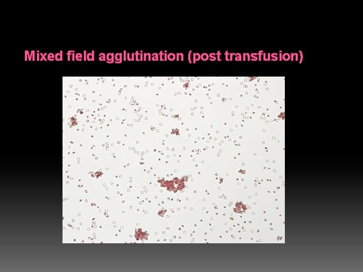 Mixed field agglutination (post transfusion) 