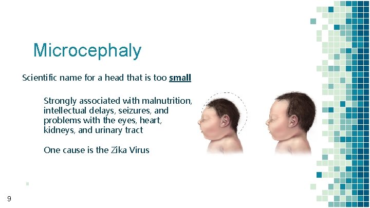 Microcephaly Scientific name for a head that is too small Strongly associated with malnutrition,