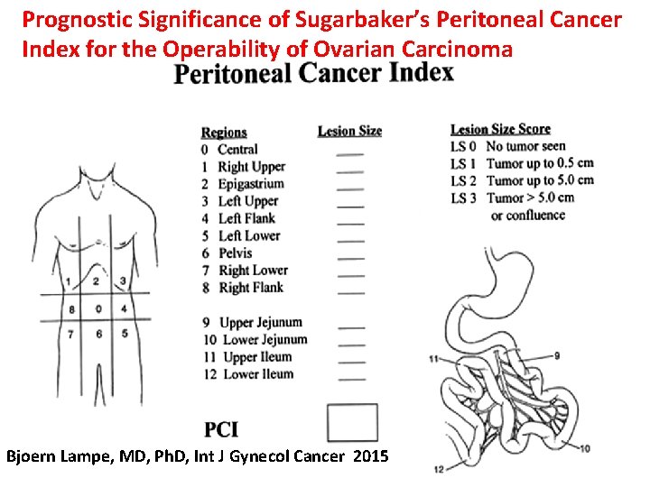 Prognostic Significance of Sugarbaker’s Peritoneal Cancer Index for the Operability of Ovarian Carcinoma Bjoern