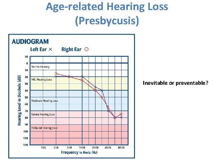 Age-related Hearing Loss (Presbycusis) Inevitable or preventable? 