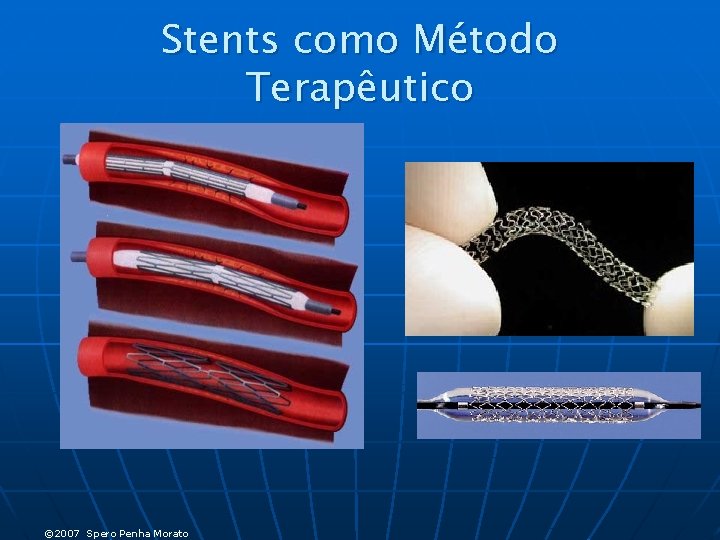 Stents como Método Terapêutico © 2007 Spero Penha Morato 