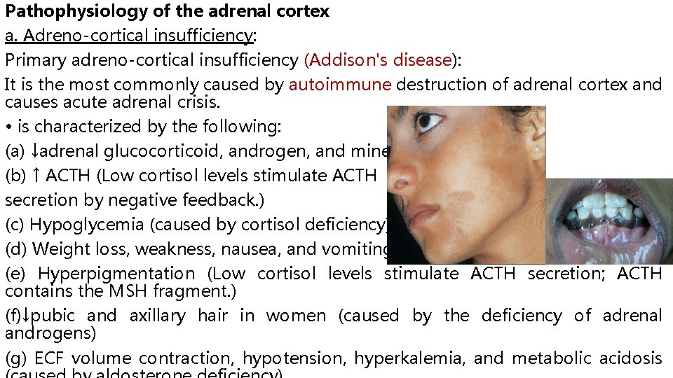 Pathophysiology of the adrenal cortex a. Adreno-cortical insufficiency: Primary adreno-cortical insufficiency (Addison's disease): It