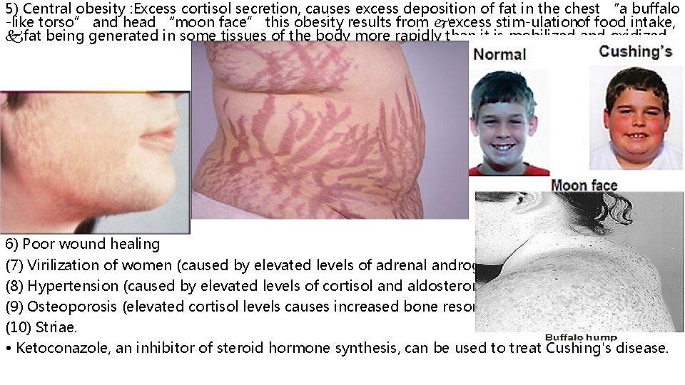 5) Central obesity : Excess cortisol secretion, causes excess deposition of fat in the