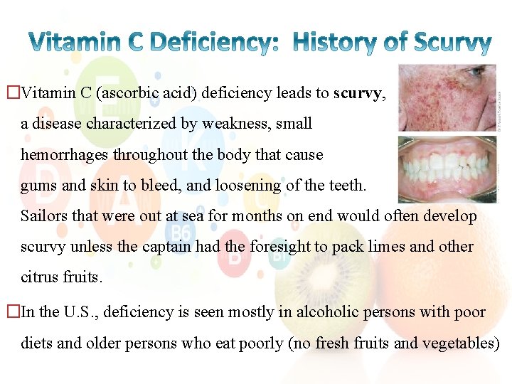 �Vitamin C (ascorbic acid) deficiency leads to scurvy, a disease characterized by weakness, small