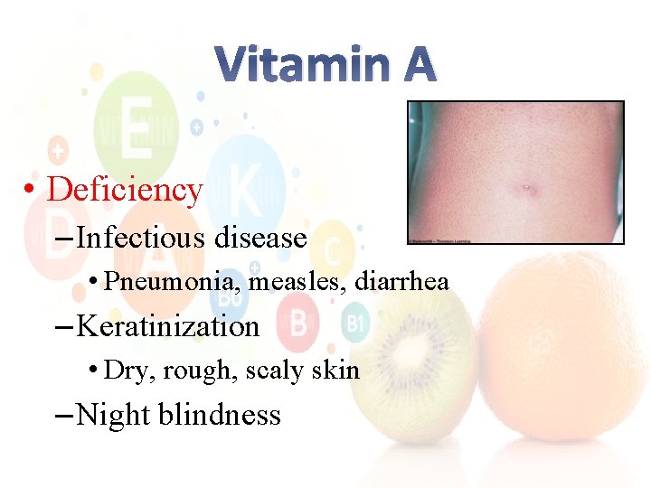 Vitamin A • Deficiency – Infectious disease • Pneumonia, measles, diarrhea – Keratinization •