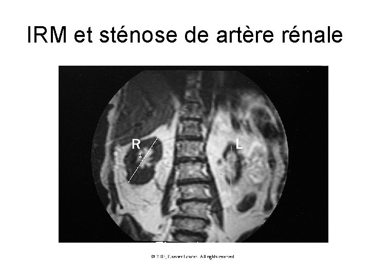 IRM et sténose de artère rénale IRM et sténose de artère rénale