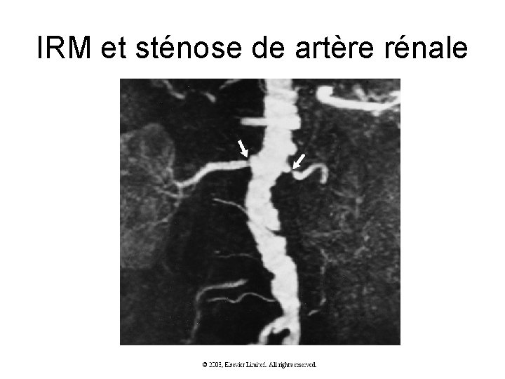IRM et sténose de artère rénale IRM et sténose de artère rénale