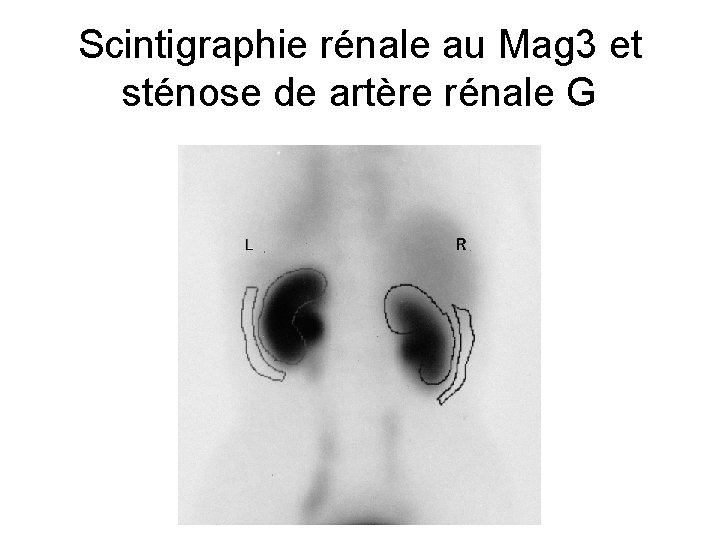 Scintigraphie rénale au Mag 3 et sténose de artère rénale G Scintigraphie rénale au Mag 3 et sténose de artère rénale G