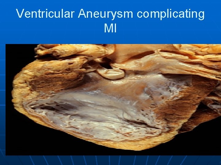 Ventricular Aneurysm complicating MI 