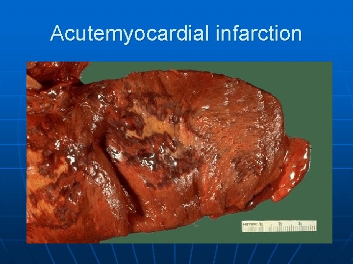 Acutemyocardial infarction 