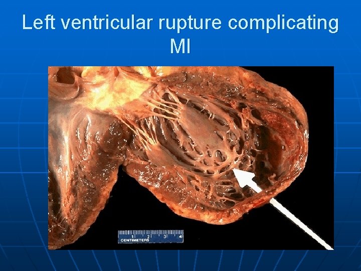 Left ventricular rupture complicating MI 