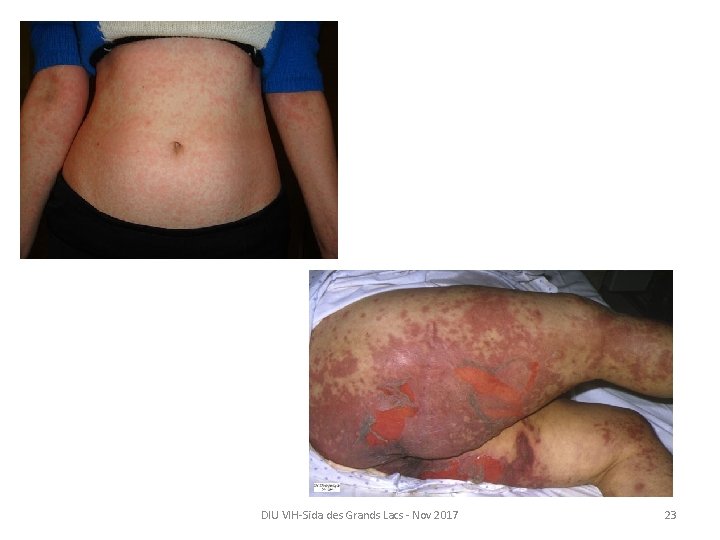 DIU VIH-Sida des Grands Lacs - Nov 2017 23 