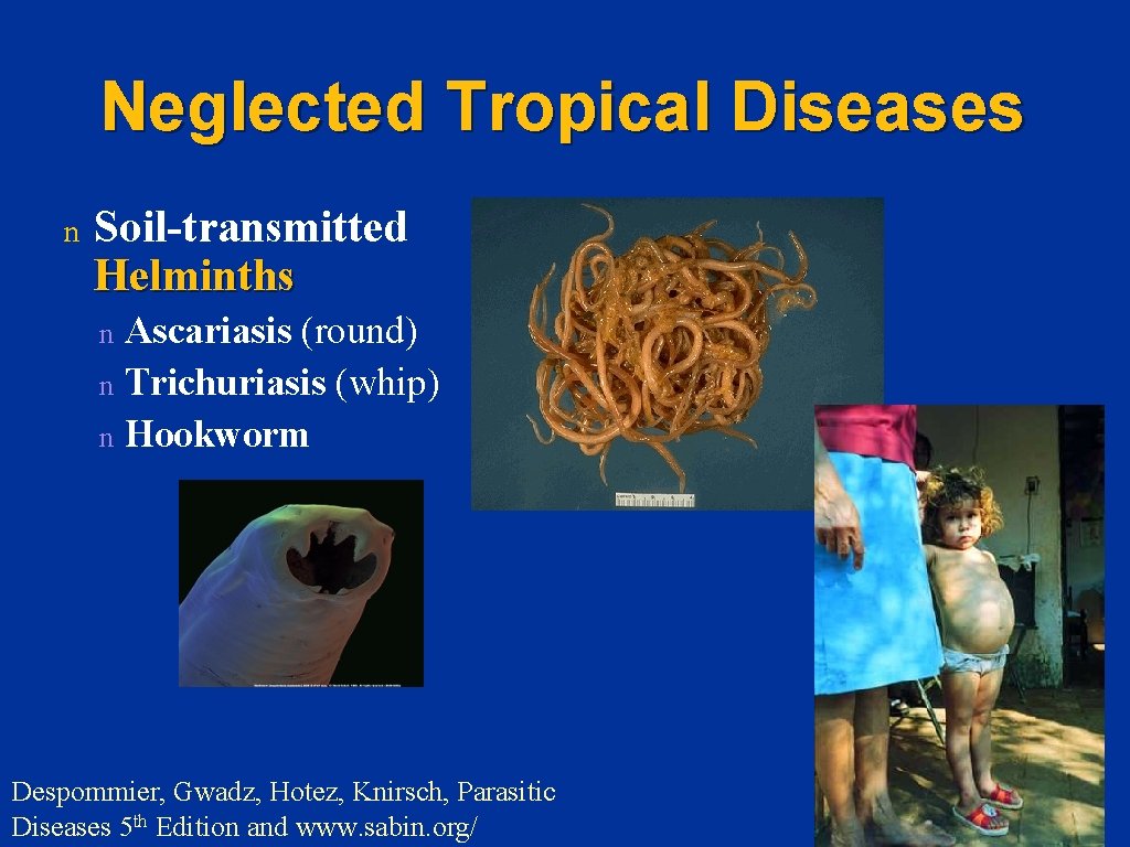 Neglected Tropical Diseases n Soil-transmitted Helminths Ascariasis (round) n Trichuriasis (whip) n Hookworm n